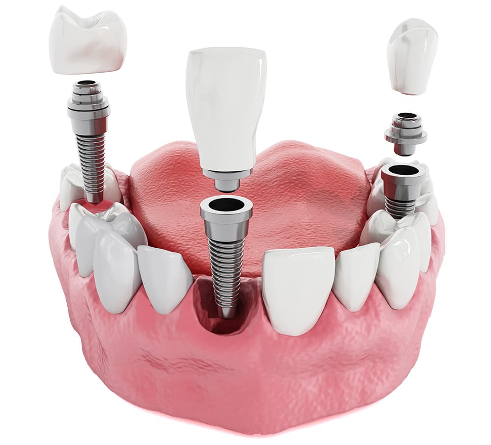 Illustratie van tandheelkundige implantaten